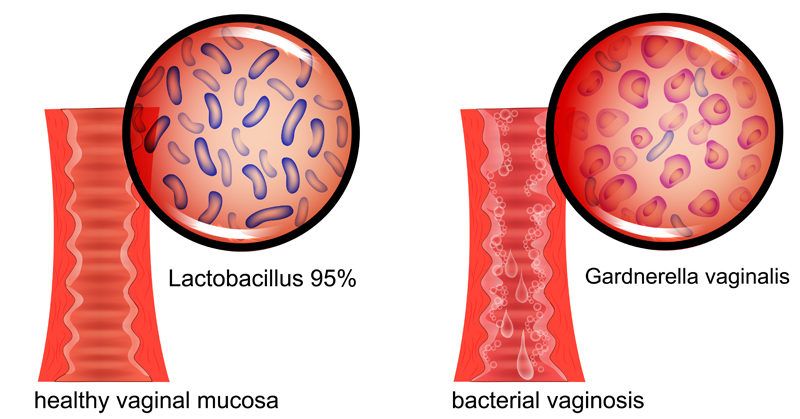 Гарднерелла (Gardnerella vaginalis), соскреб, моча, методом ПЦР Real-Time, качественное определение