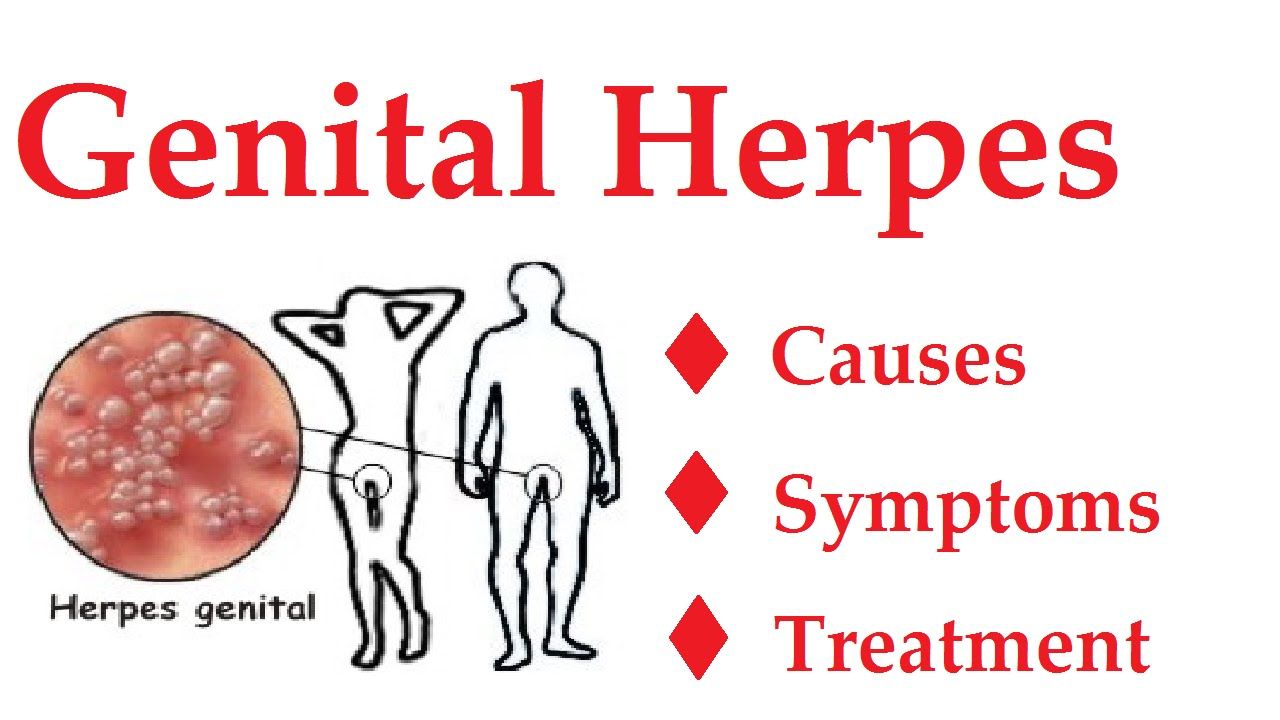 Herpes genital symptoms
